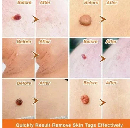 PARCHE REMOVEDOR DE VERRUGAS - ELIMINA LAS VERRUGAS EN DIAS- ENVÍO GRATIS